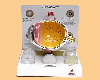 Cataract #15129